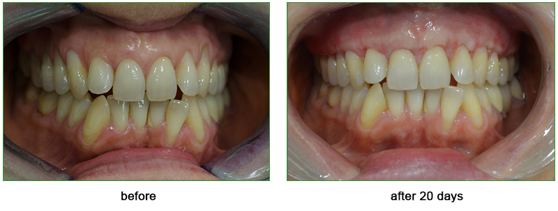 result of the treatment of the gum recession using Alloderm 20 days after the surgery result of the treatment of the gum recession using Alloderm 20 days after the surgery