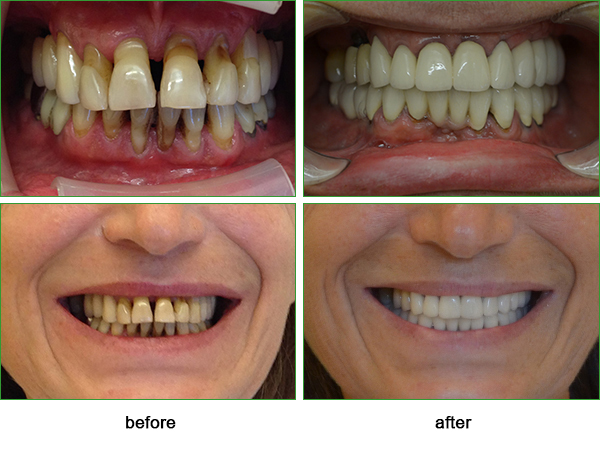 inflamation of the gums in very advanced stage and the result after treatment inflamation of the gums in very advanced stage and the result after treatment