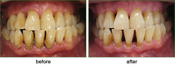 dental tartar buil-up dental tartar build-up